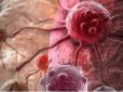 Бережіться! Онколог назвав доведені фактори розвитку раку
